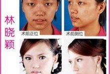 微整形隆鼻最新爆料视频,网红爆料视频大揭秘